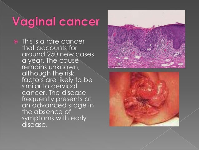 Adenocarcinoma of the vulva photos 55